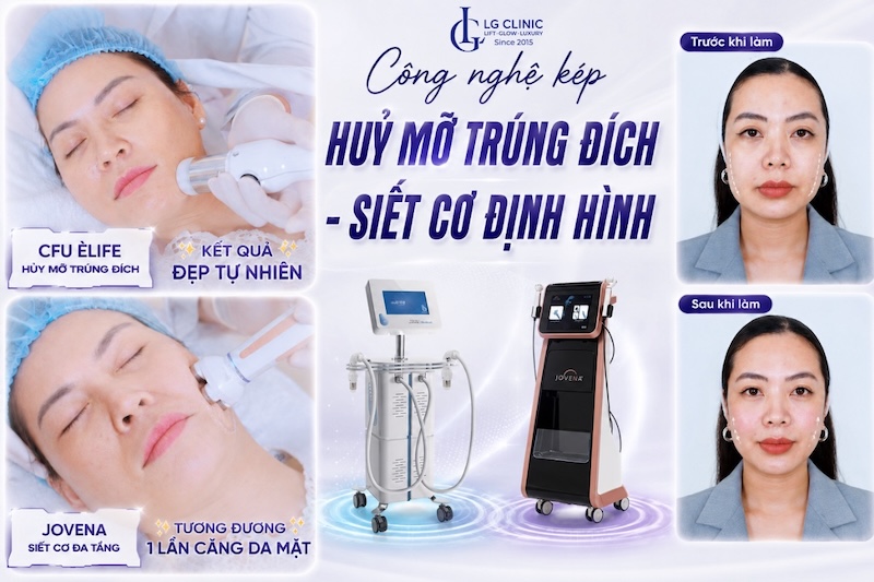 xoá nọng cằm không xâm lấn