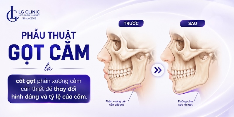 Gọt cằm có vĩnh viễn không