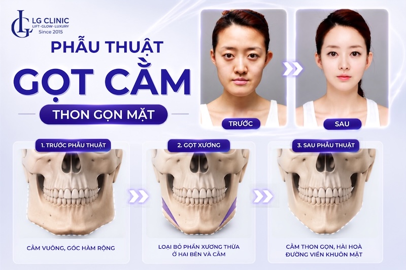 phẫu thuật gọt cằm