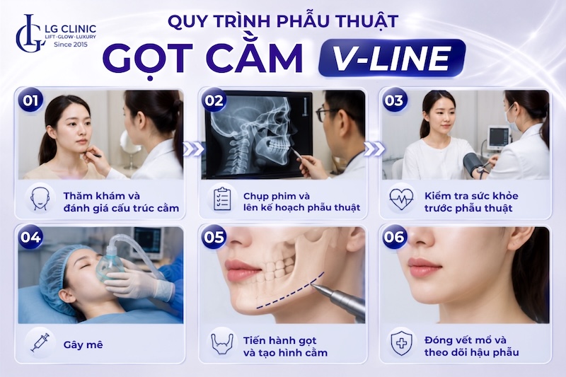 gọt cằm v line