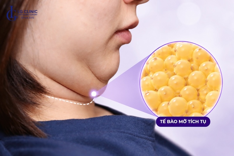 hút mỡ nọng cằm