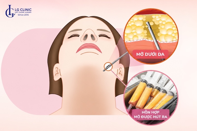 hút mỡ nọng cằm
