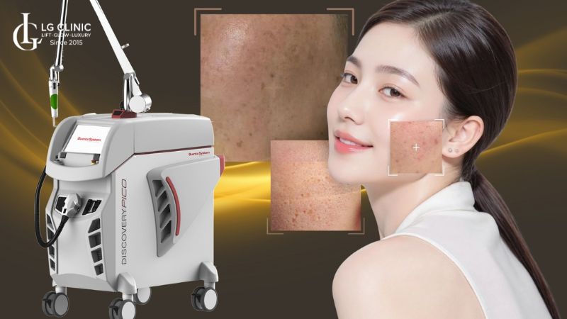 laser discovery pico giá bao nhiêu