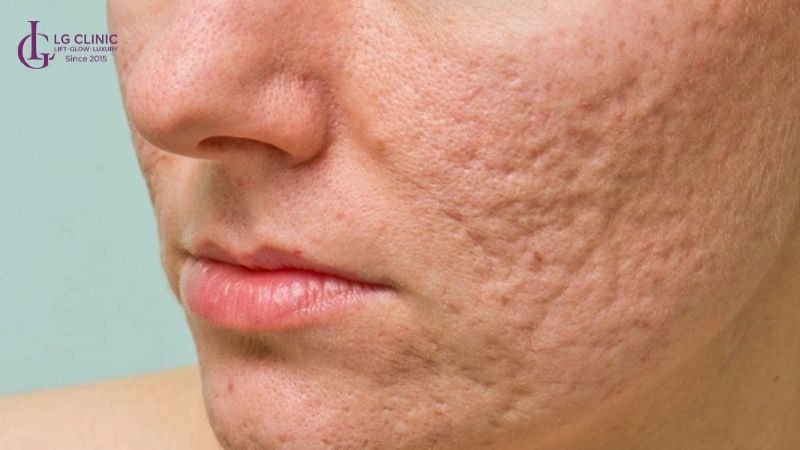 Laser Pico và Laser CO2 khác nhau như thế nào
