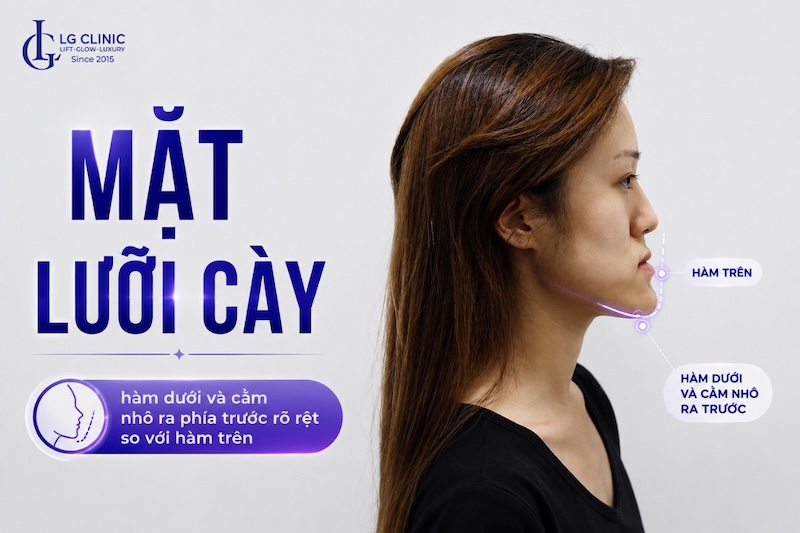 mặt lưỡi cày