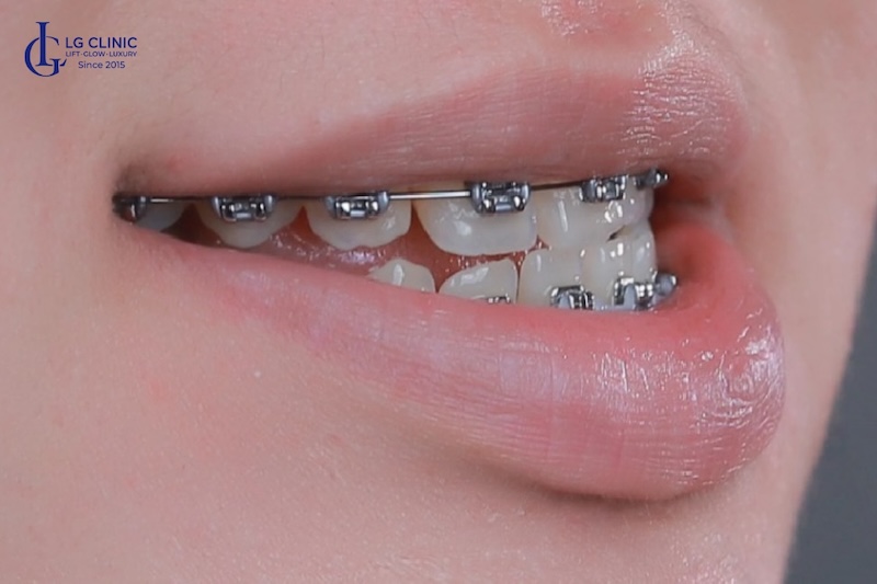niềng răng mặt lưỡi cày