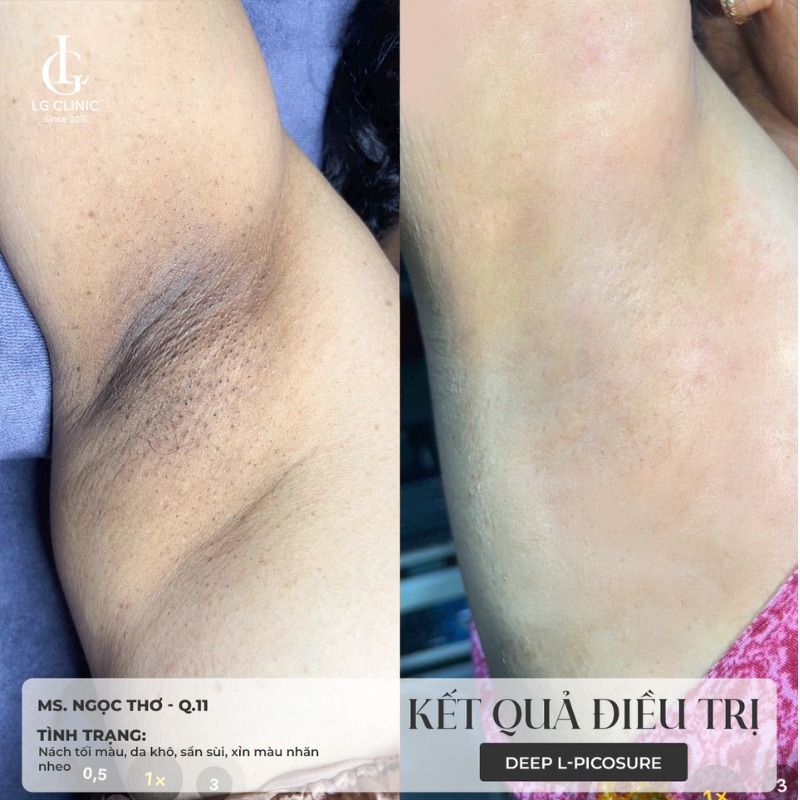 Muối nhôm có làm thâm nách không