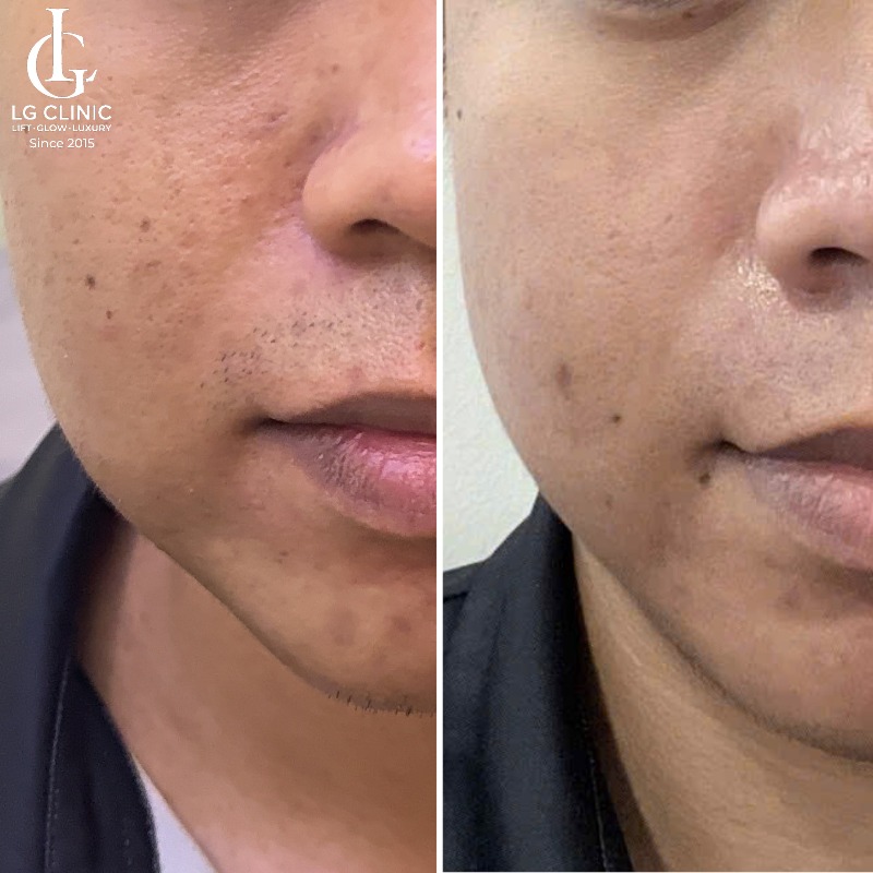 Sau laser bao lâu được dùng retinol