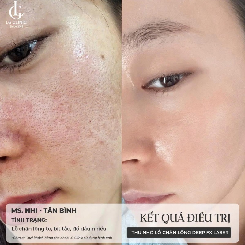 spa thu nhỏ lỗ chân lông Bình Tân