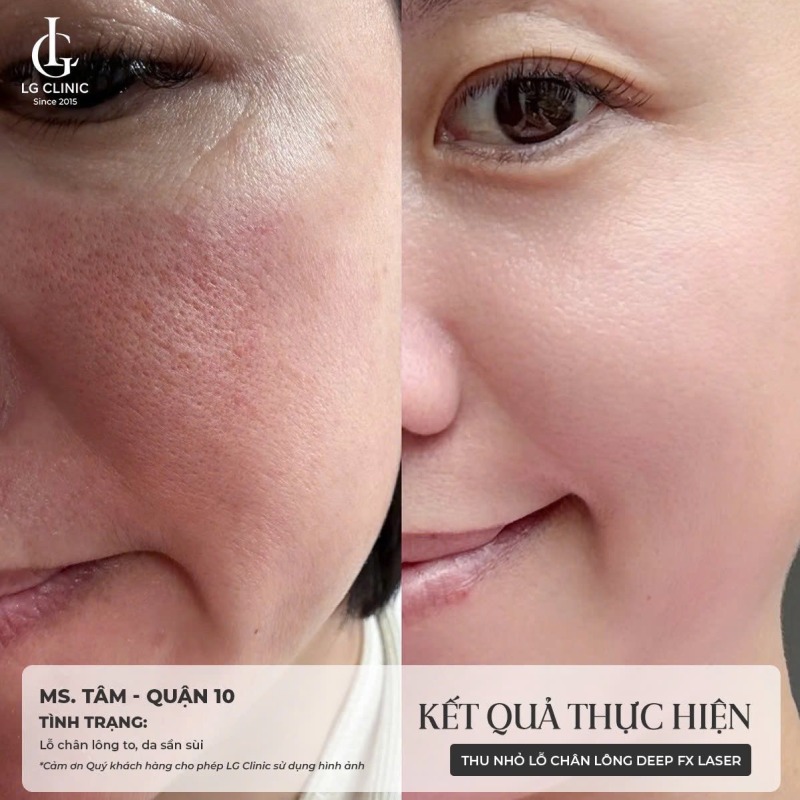 spa thu nhỏ lỗ chân lông Bình Tân