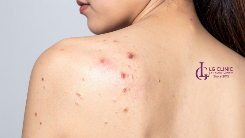 Spa trị mụn lưng Bình Tân