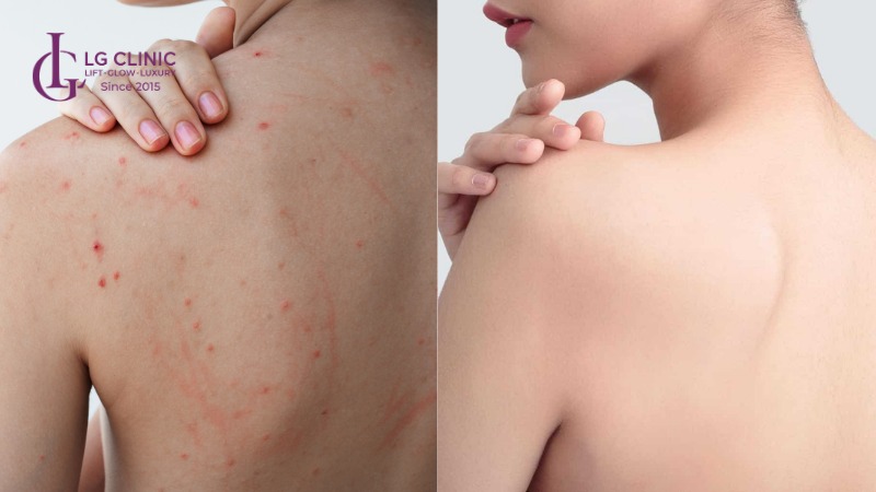 Spa trị mụn lưng Bình Tân
