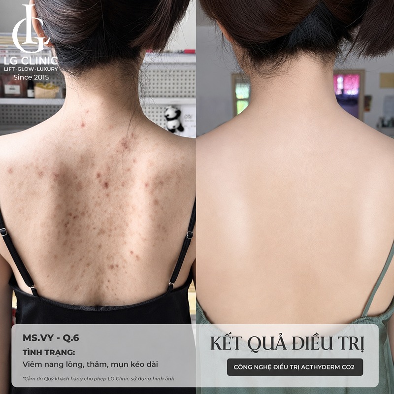 Spa trị mụn lưng Bình Tân