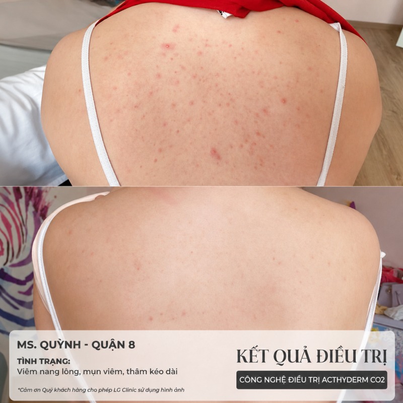 spa trị mụn lưng Gò Vấp