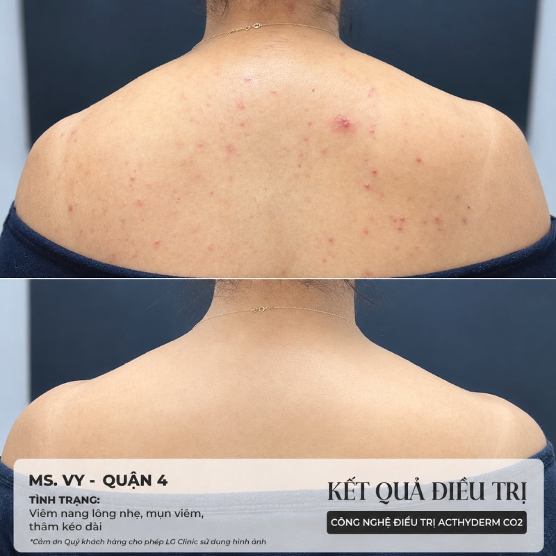 spa trị mụn lưng Gò Vấp
