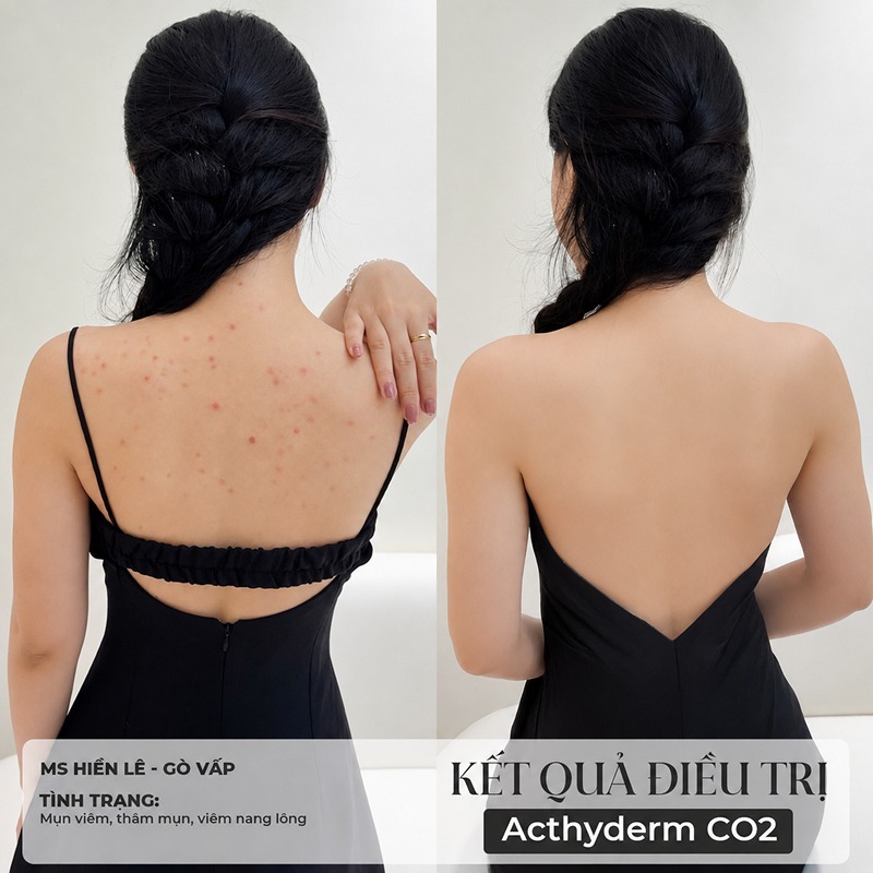 spa trị mụn lưng quận 3