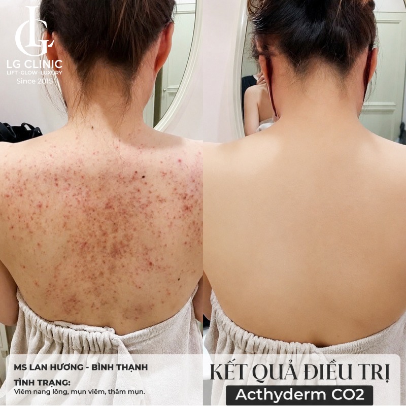 spa trị mụn lưng quận 3