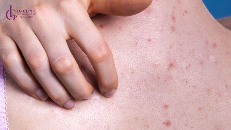 Spa trị mụn lưng Tân Phú