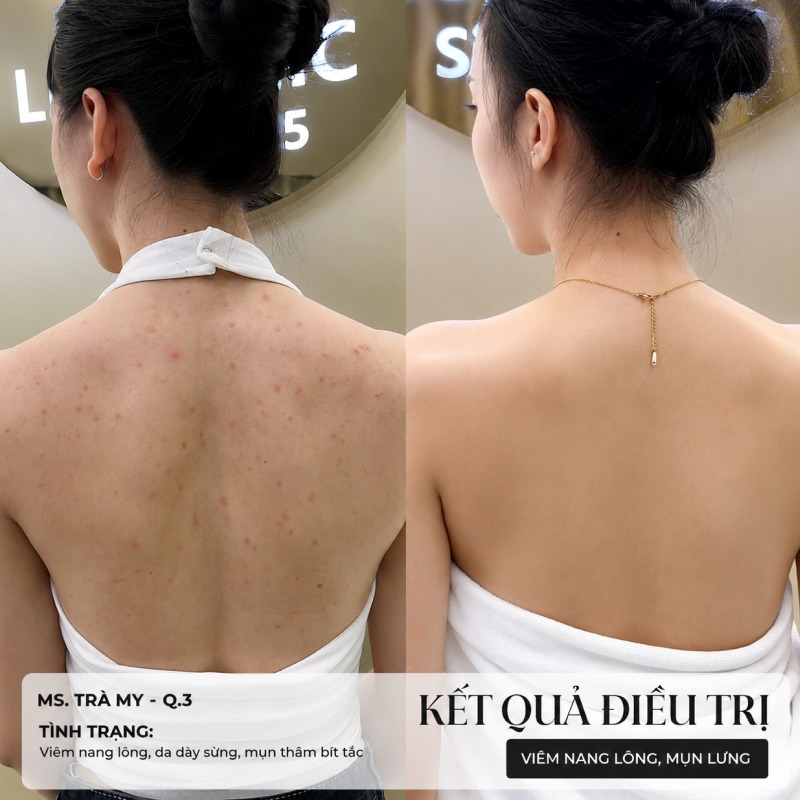 Spa trị mụn lưng Tân Phú