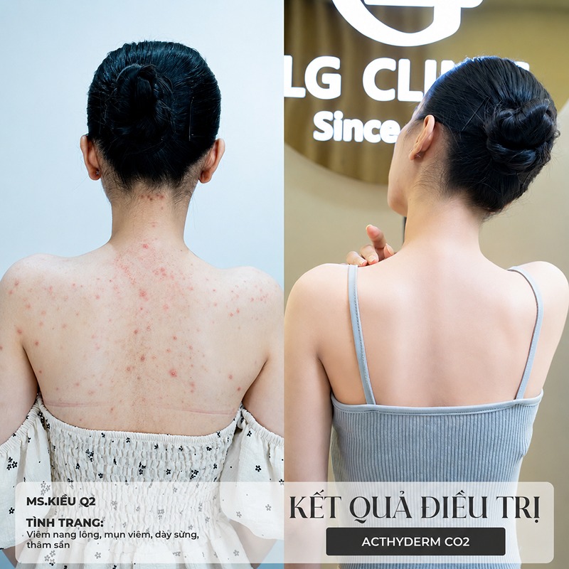 Spa trị mụn lưng Tân Phú