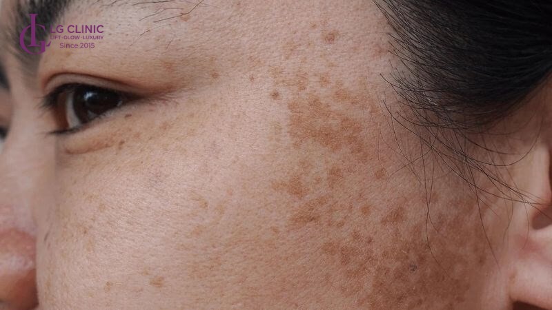 spa trị nám bình tân