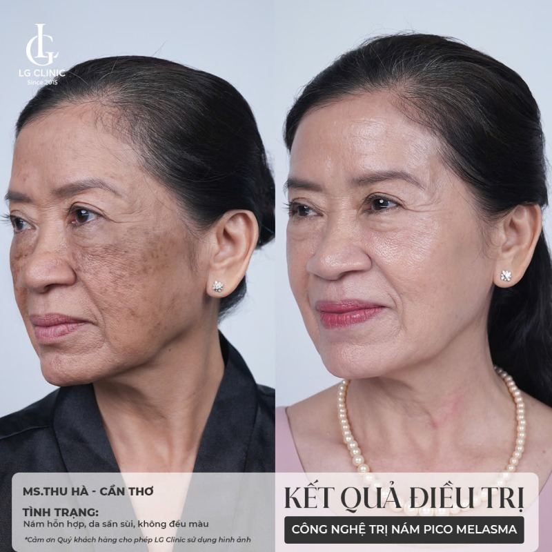 spa trị nám bình tân