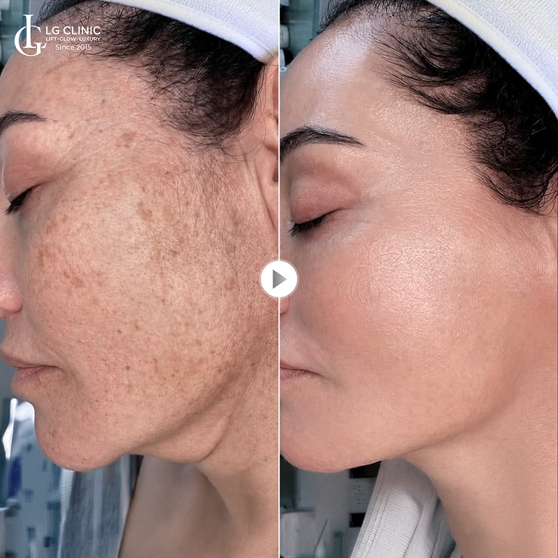spa trị nám tại quận 3