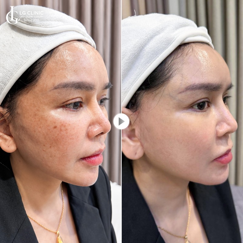 spa trị nám tại quận 3