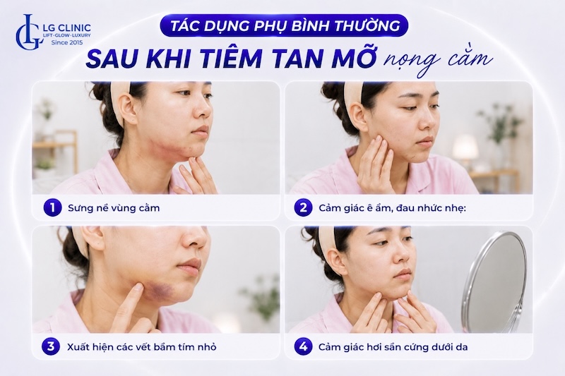 tiêm tan mỡ nọng cằm kiêng gì
