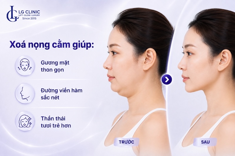 nọng cằm có tốt không