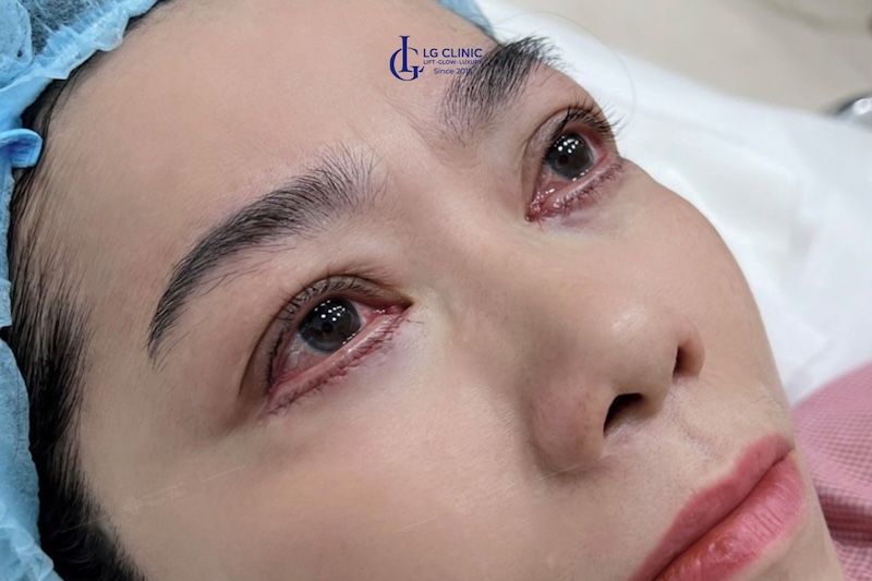 điều trị bọng mắt chảy xệ