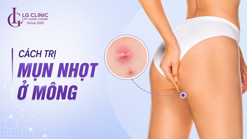 Cách trị mụn nhọt ở mông