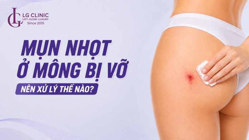 Cách trị mụn nhọt ở mông