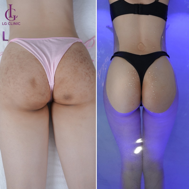 Cách trị mụn nhọt ở mông