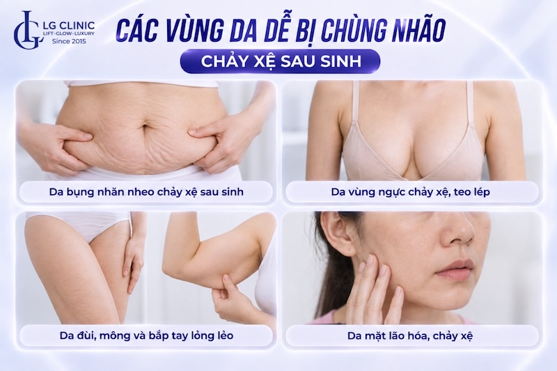 da chùng nhão chảy xệ sau sinh