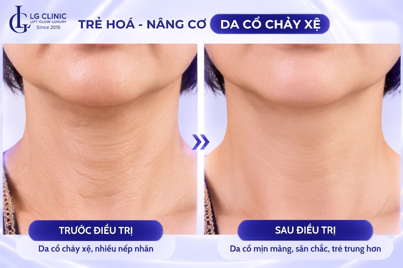 điều trị da cổ chảy xệ