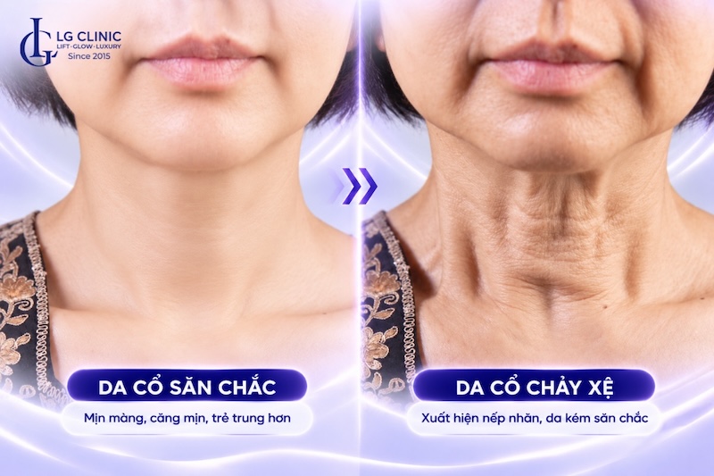 da cổ bị chảy xệ