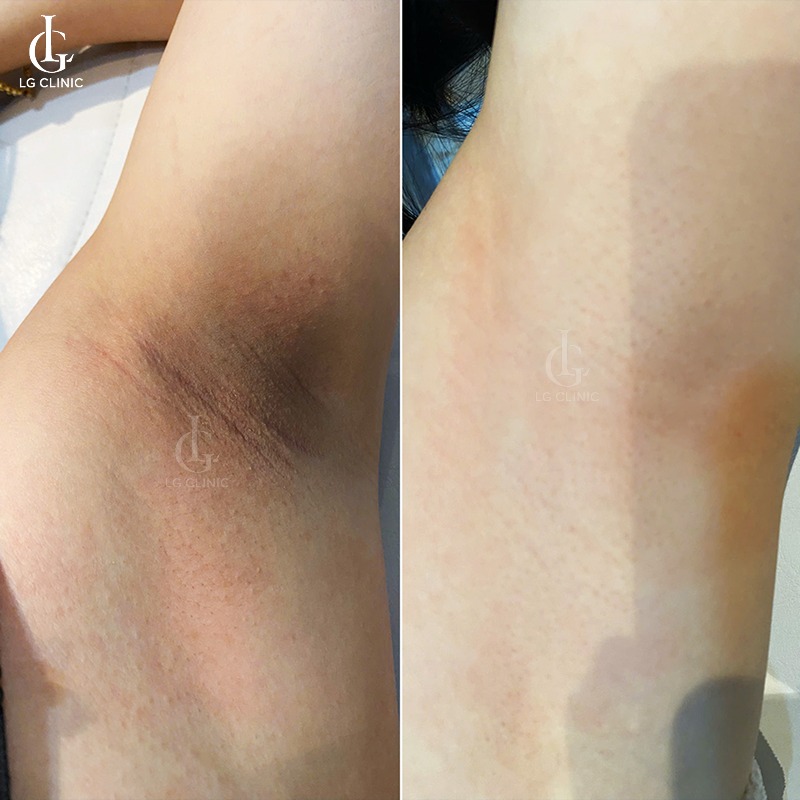 dầu em bé có trị thâm nách không