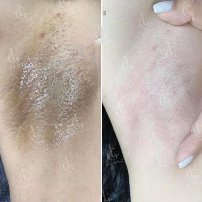 dầu em bé có trị thâm nách không