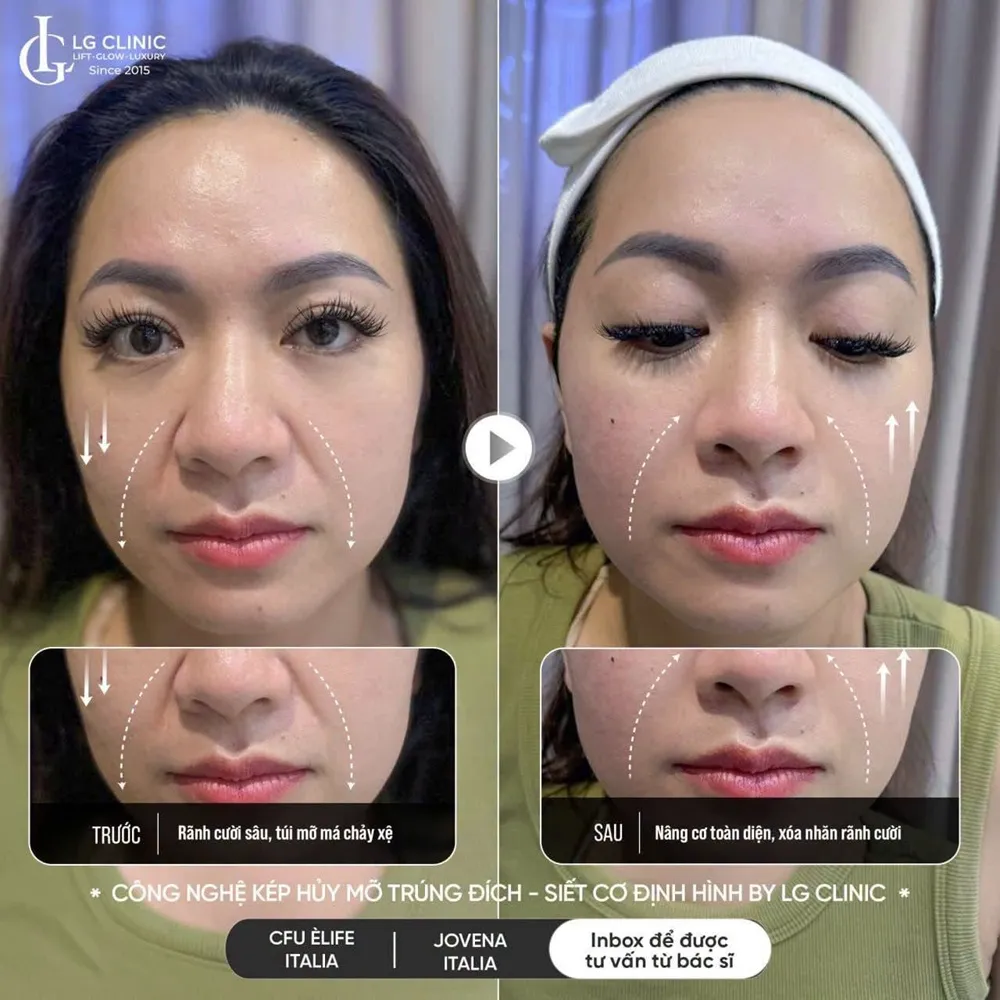 hình ảnh ba rãnh cười