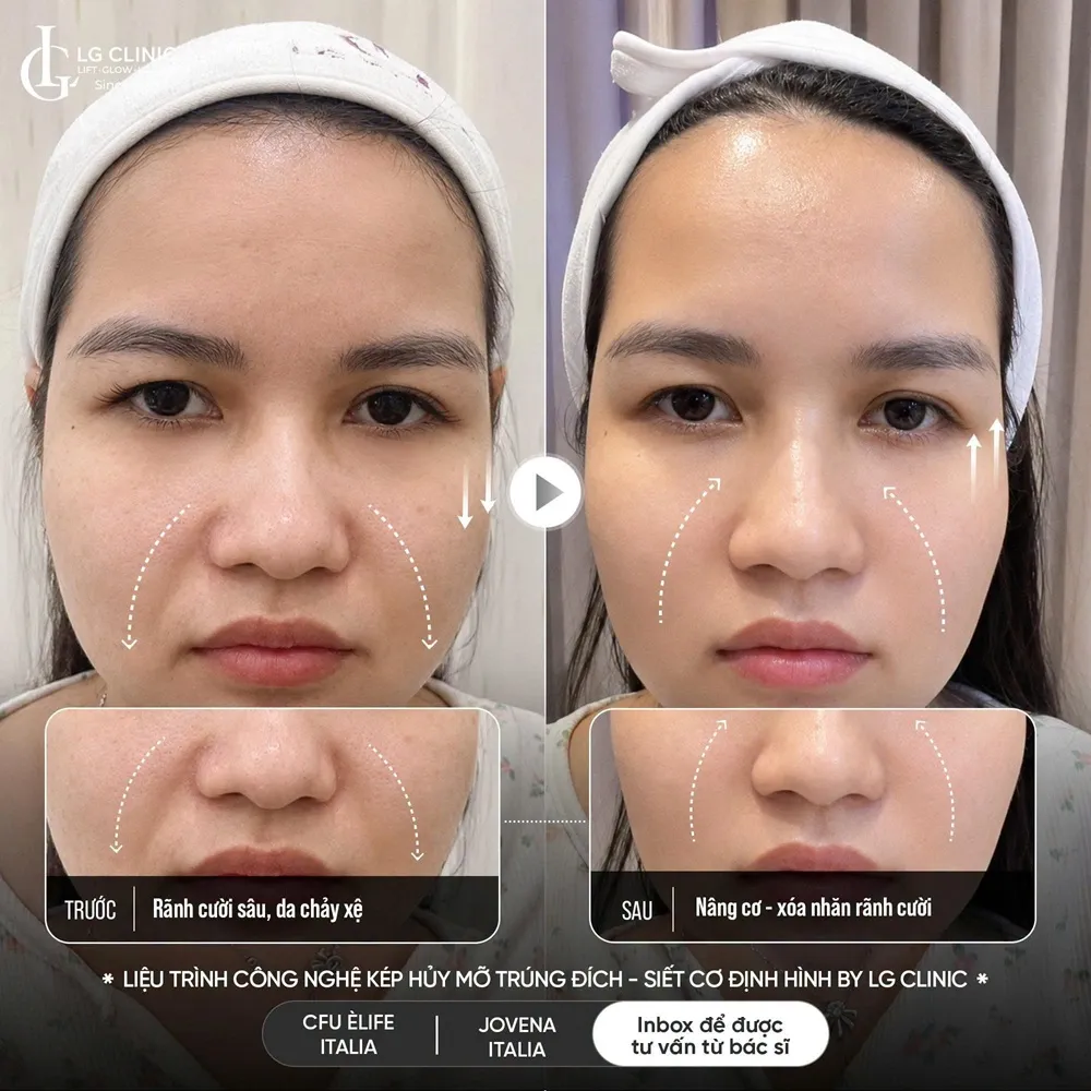 hình ảnh ba rãnh cười