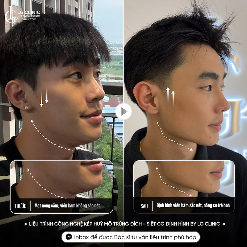 kết quả giảm mỡ mặt bằng cfu