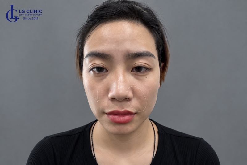 má bị chảy xệ