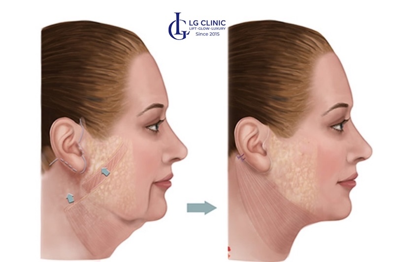 mặt bị chảy xệ một bên