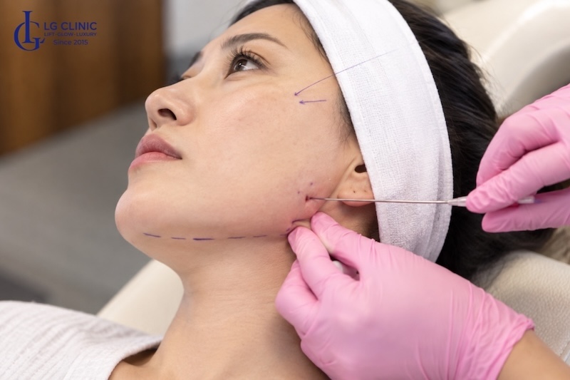 điều trị mặt bị chảy xệ 1 bên