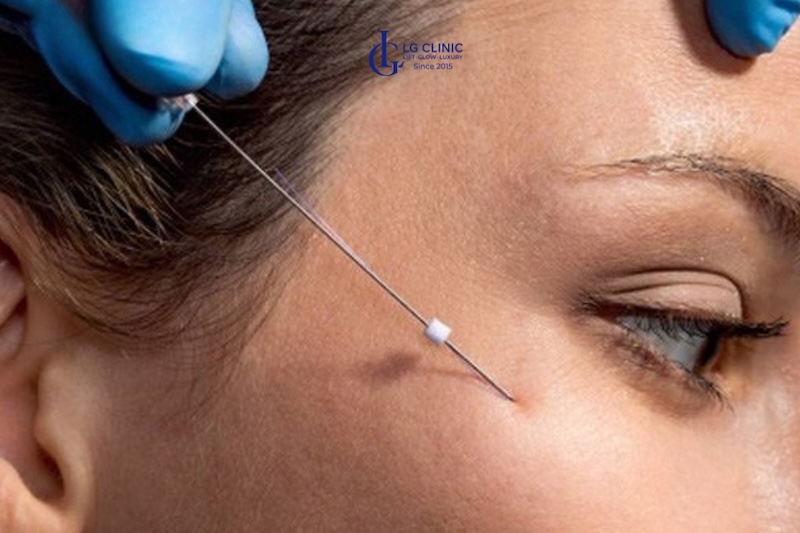 cách khắc phục mí mắt chảy xệ