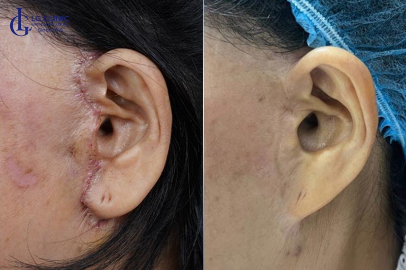 Phẫu thuật căng da để nâng cơ mặt chảy xệ toàn diện