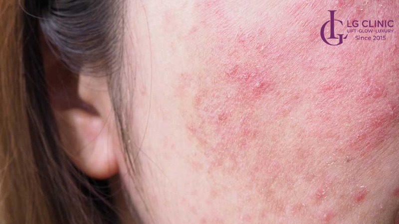 Sau laser bao lâu được tẩy da chết
