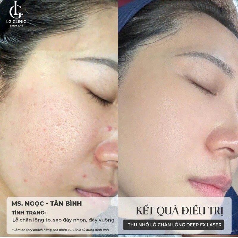 spa thu nhỏ lỗ chân lông Vũng Tàu