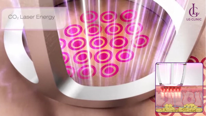 spa trị rạn da uy tín